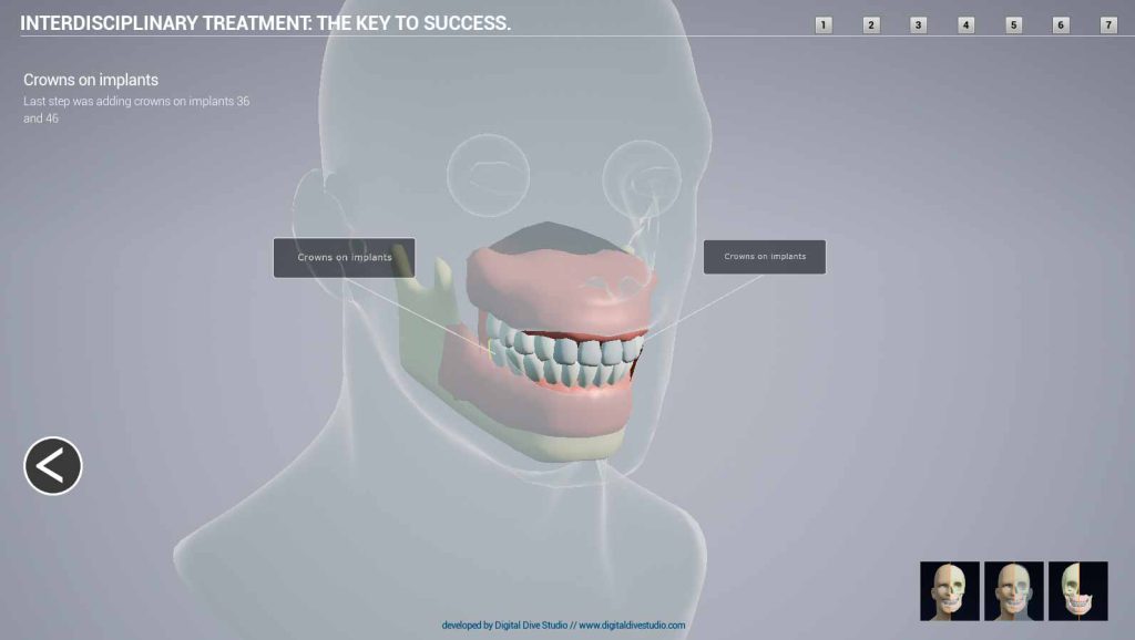 Periodontology 3d model for didactic purposes
